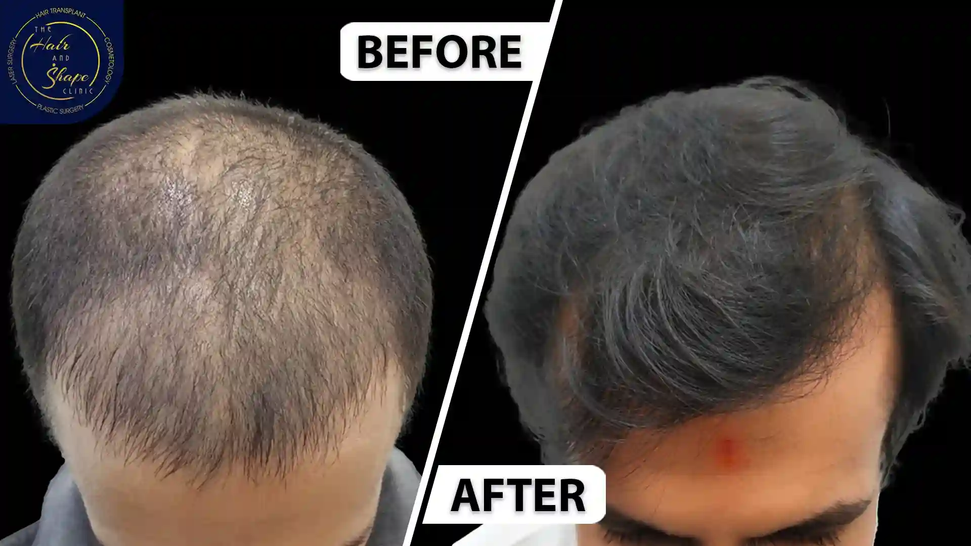 PRP Treatment result8